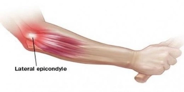 Dirsek Kemik Ağrısı Belirtileri ve Tedavisi