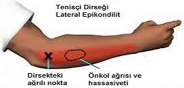 Dirsekte Su Toplanması Belirtileri ve Tedavisi