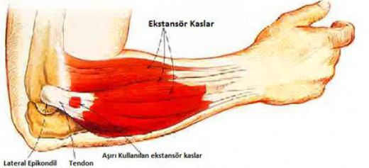 Tenisi Dirsei Nasl Geer