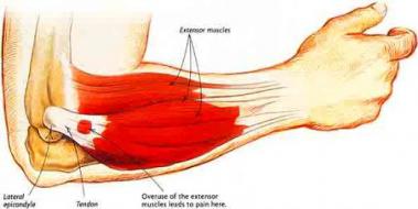 Dirsek Tendon Ars